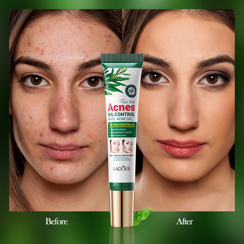 SADOER Tea Tree Acne Control Oil Gel 20g