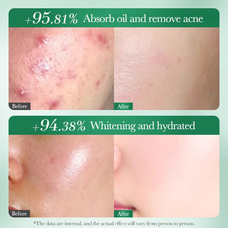 SADOER Salicylic Acid Niacinamide Tea Tree Whitening Acne Cleanser 100g